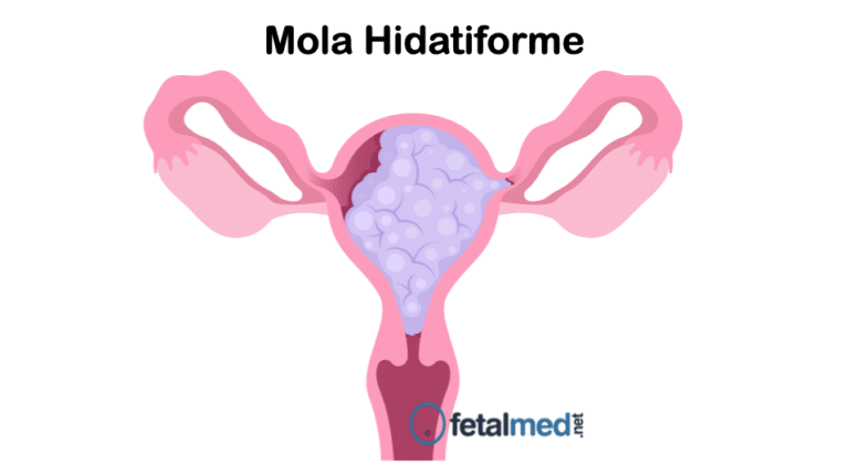 Tudo Sobre Mola Hidatiforme Fetalmed