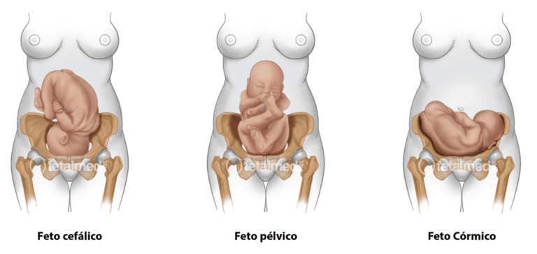 Quando O Bebê Vai Encaixar Fetalmed Medicina Fetal Curitiba 