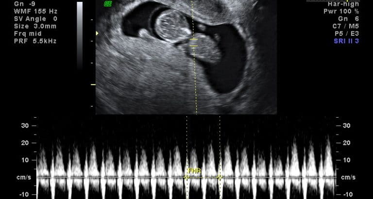 Ecografia Fetalmed Medicina Fetal Em Curitiba 