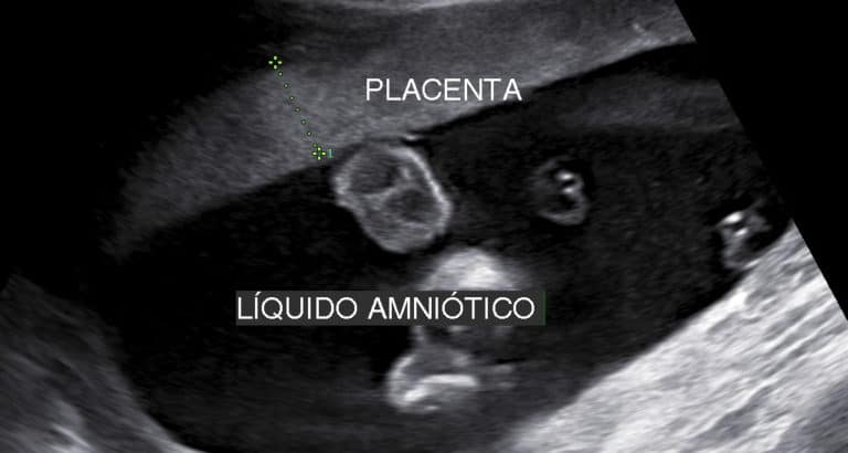 Biometria Fetalmed Medicina Fetal Em Curitiba 