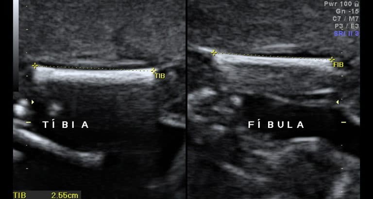 Biometria Fetalmed Medicina Fetal Em Curitiba 