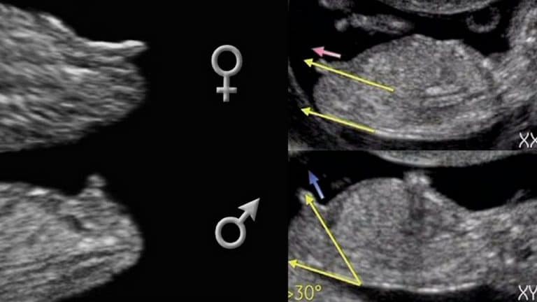 Com Que Idade Gestacional é Possível Ver O Sexo Do Bebê No Ultrassom 