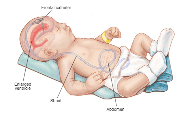 Calculadora De Chance De DVP Na Cirurgia Intra Uterina Para 