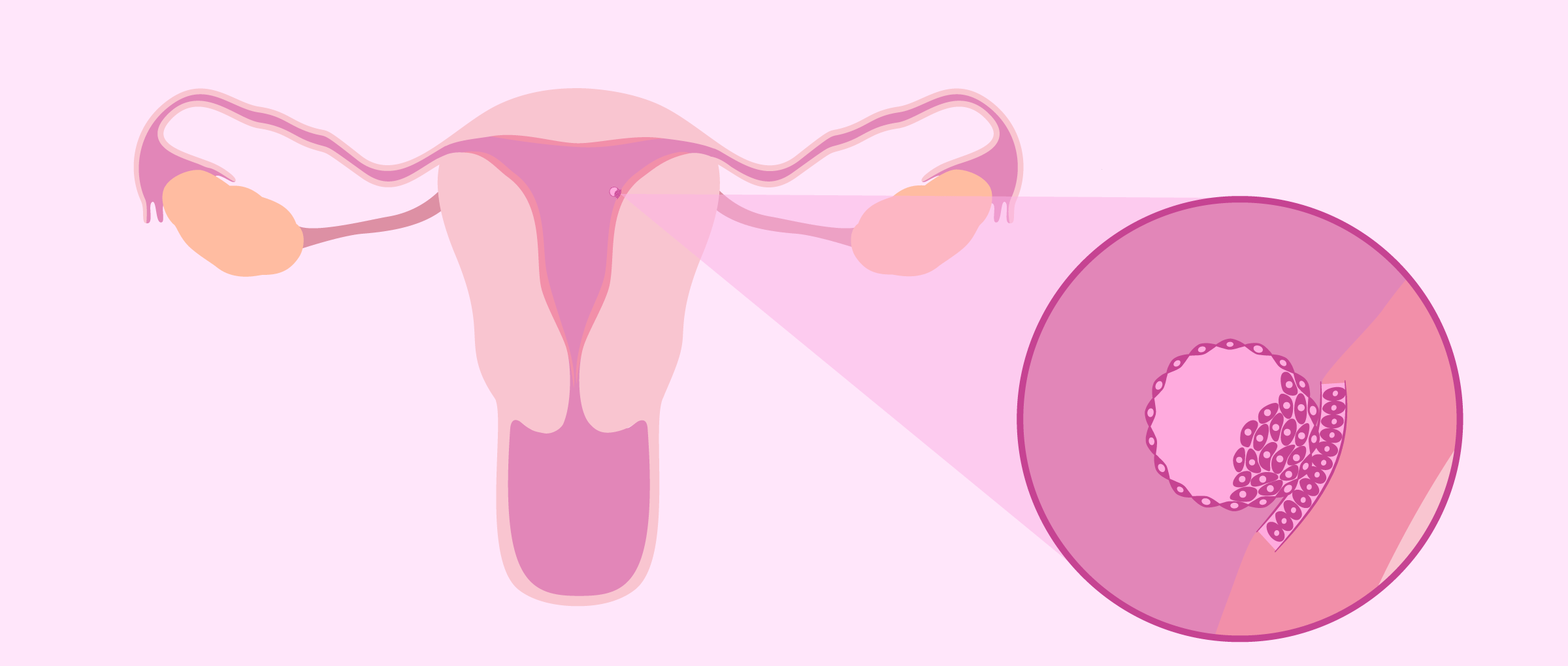 Nidação ou menstruação??