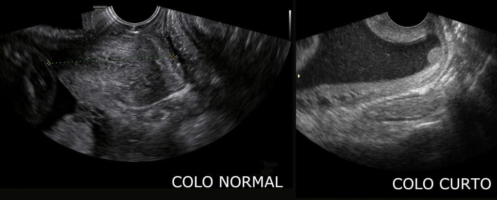 o que é a medida do colo uterino na gravidez fetalmed medicina fetal