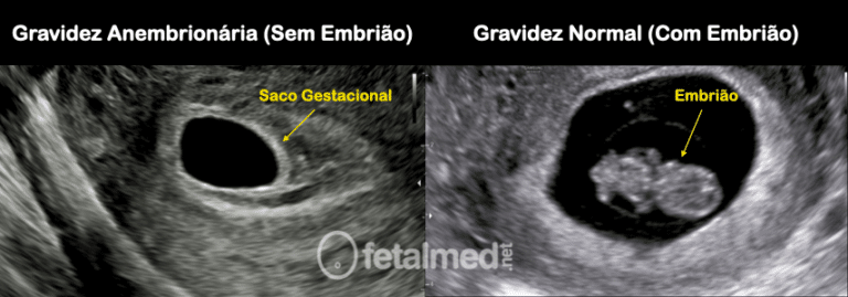 Gravidez Anembrionária Mitos E Fatos Fetalmed 