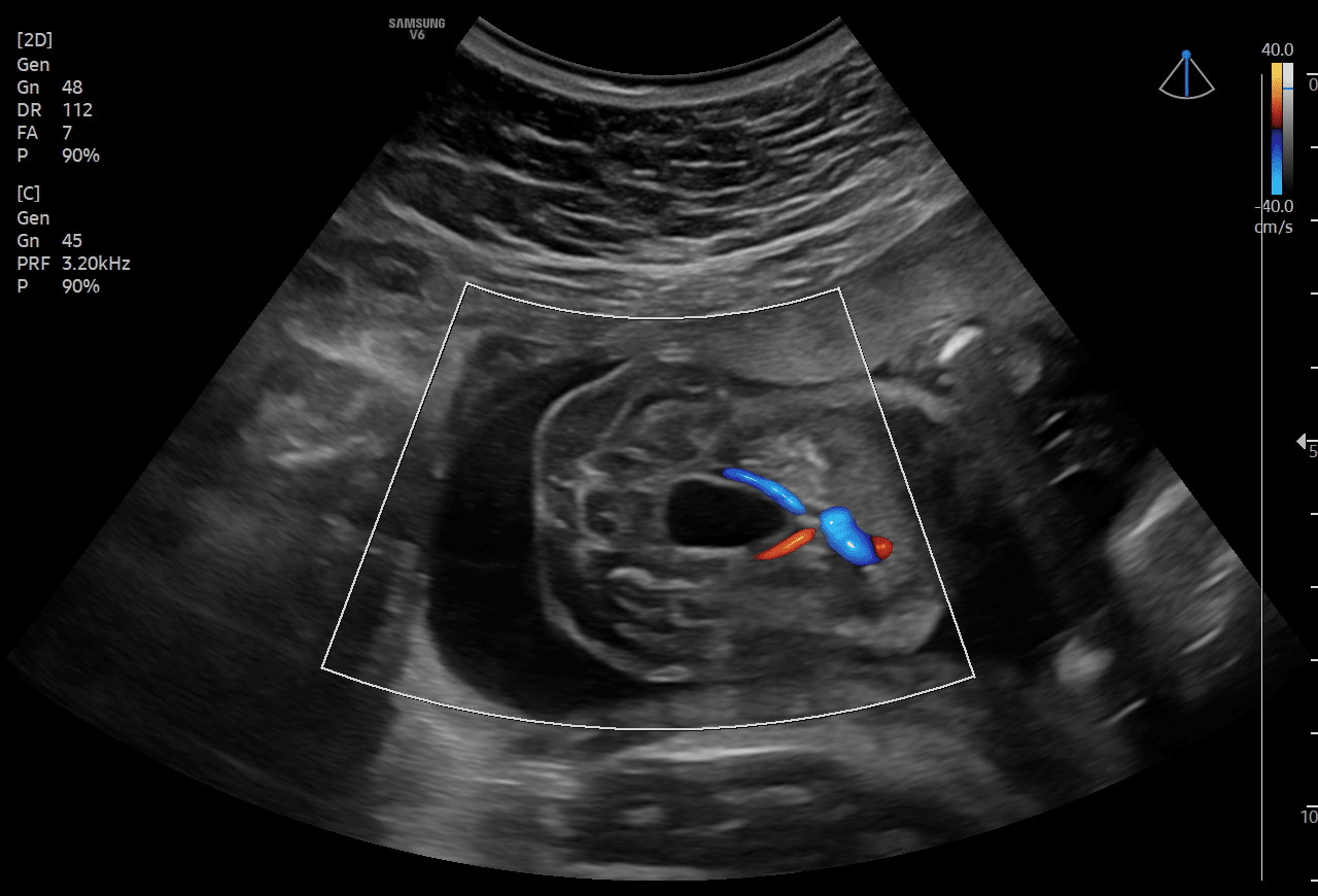 Ultrassom da Bexiga Fetal