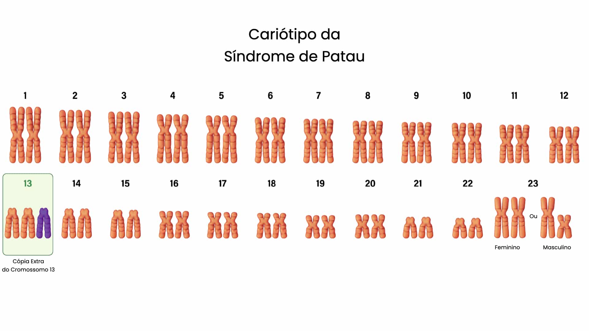 Cariótipo da Síndrome de Patau